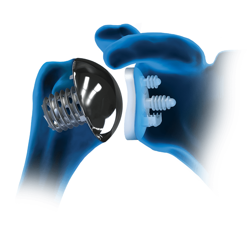 Arthrex Eclipse™ Total Shoulder System